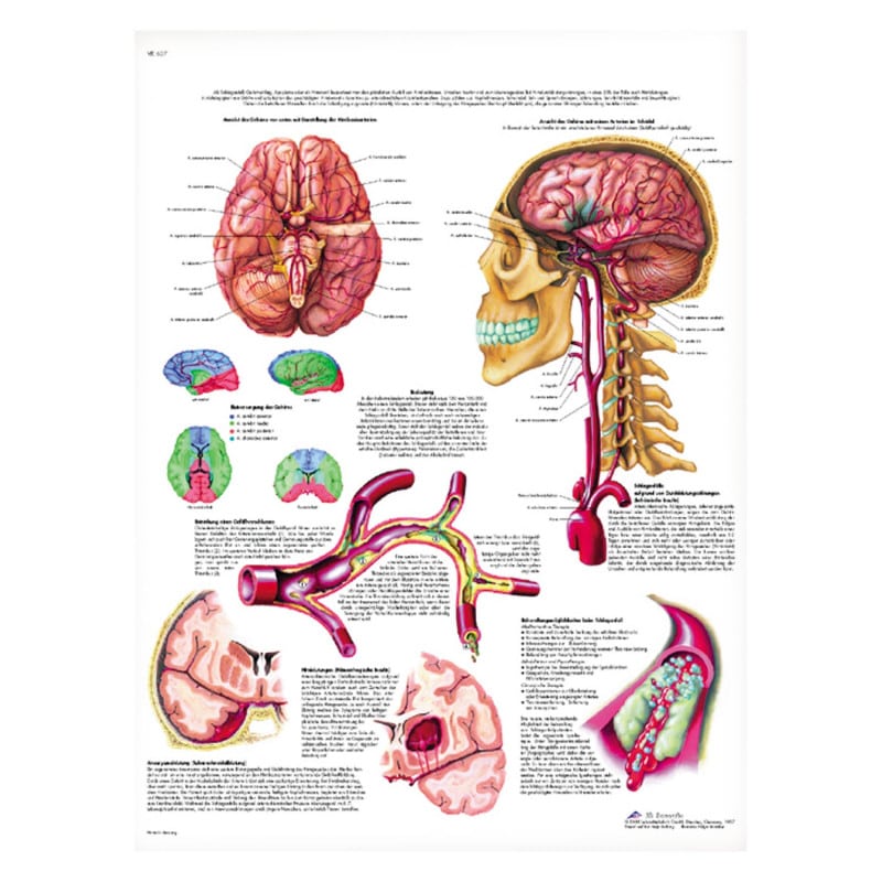 Stroke Wall Chart French