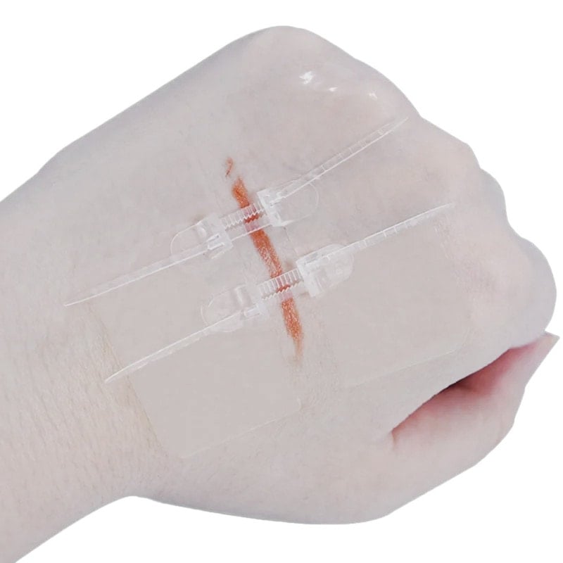 Zip Wound Closure Device G1 6 x 20 cm