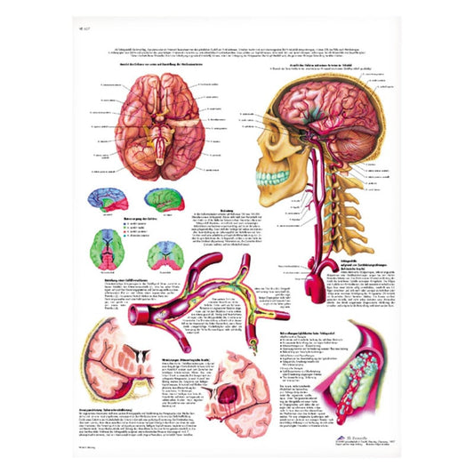 Stroke Wall Chart French