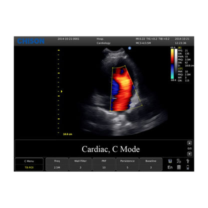 CHISON ECO5 Ultrasound Machine with Color Doppler + convex transducer