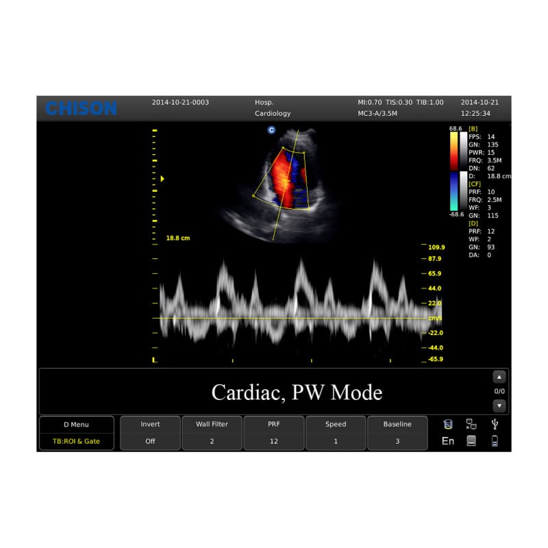 CHISON ECO5 Ultrasound Machine with Color Doppler + convex transducer