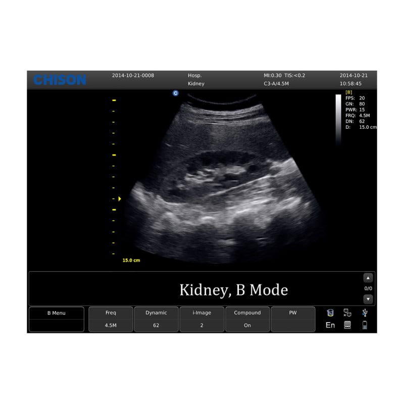CHISON ECO5 Ultrasound Machine with Color Doppler + convex transducer