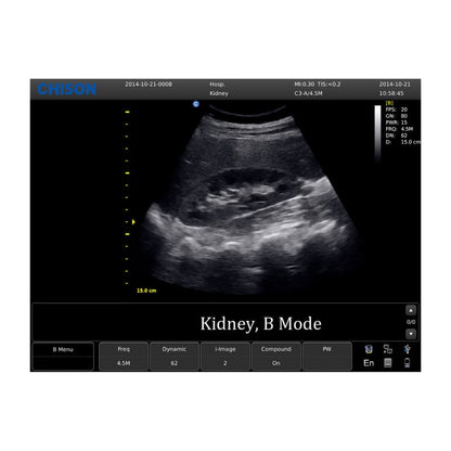 CHISON ECO5 Ultrasound Machine with Color Doppler + convex transducer
