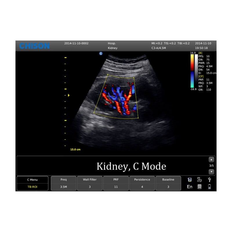 CHISON ECO5 Ultrasound Machine with Color Doppler + linear transducer