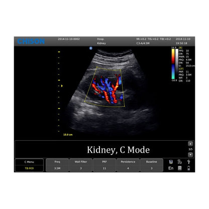 CHISON ECO5 Ultrasound Machine with Color Doppler + linear transducer