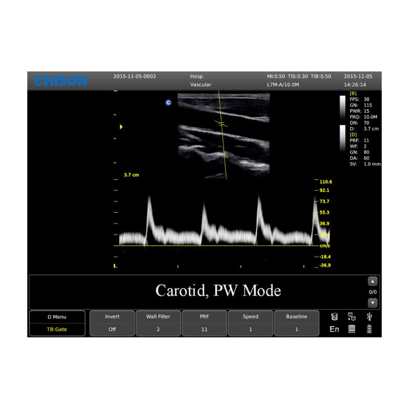 CHISON ECO3 incl. Ultrasound Trolley with linear probe