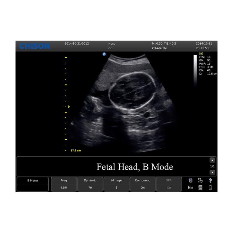 CHISON ECO3 incl. Ultrasound Trolley with convex probe