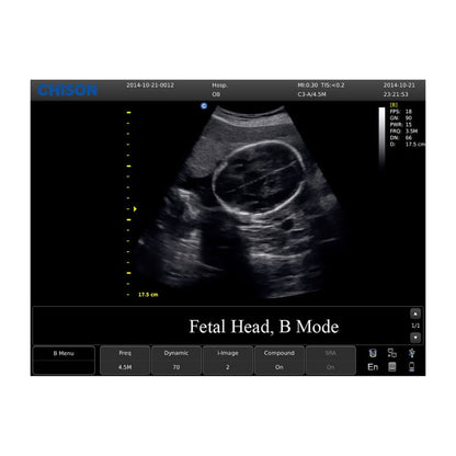 CHISON ECO3 incl. Ultrasound Trolley with convex probe