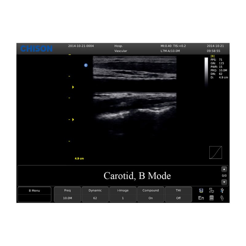 Chison ECO 1 Ultrasound Machine without rechargeable battery | linear transducer (L7M-A)