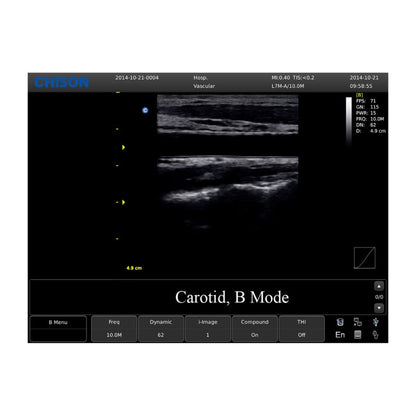 Chison ECO 1 Ultrasound Machine without rechargeable battery | linear transducer (L7M-A)
