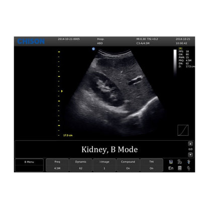 Chison ECO 1 Ultrasound Machine with rechargeable battery | convex transducer (C3-A)