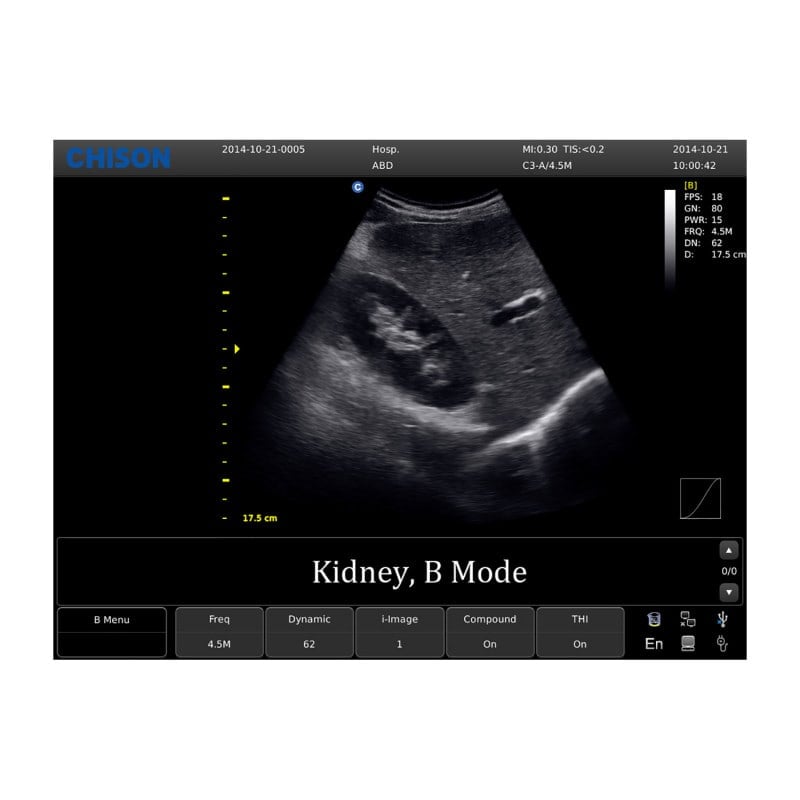 CHISON ECO1 incl. Ultrasound Trolley with battery | with convex probe
