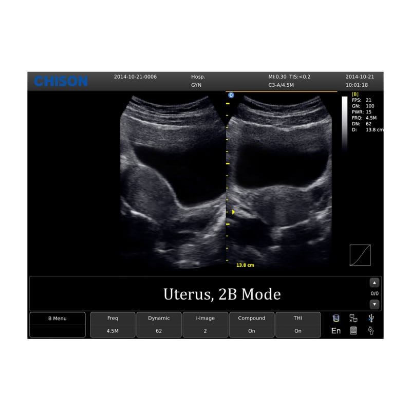 CHISON ECO1 incl. Ultrasound Trolley with battery | with convex probe