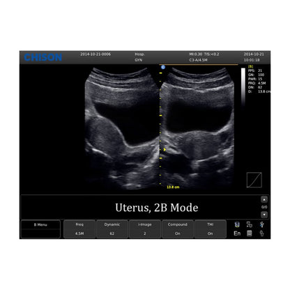 CHISON ECO1 incl. Ultrasound Trolley with battery | with convex probe