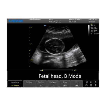 CHISON ECO6 incl. Ultrasound Trolley with linear probe