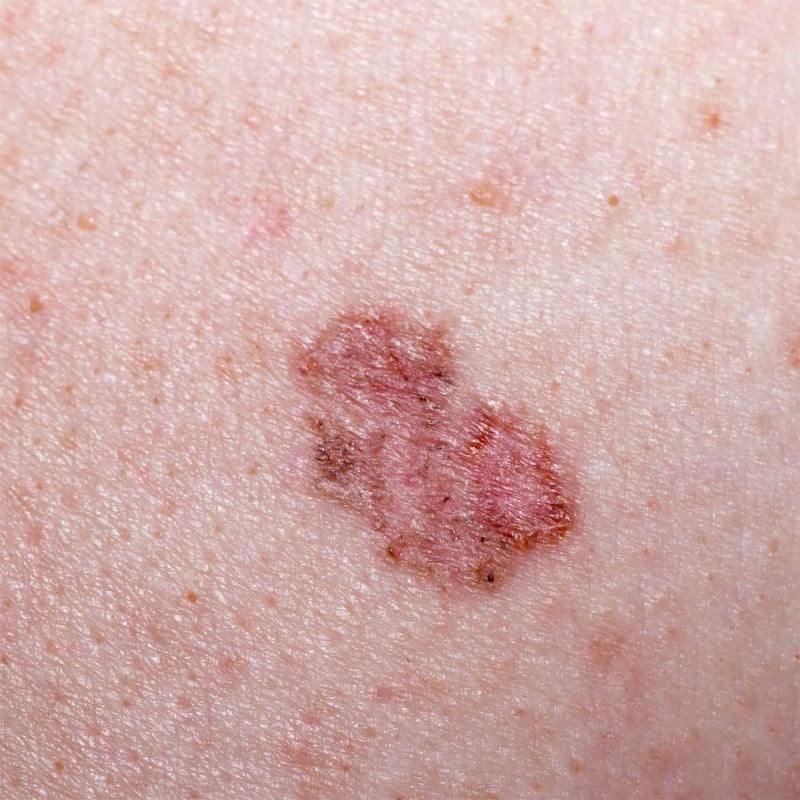 LuxaScope CCT Dermatoscope with scaling