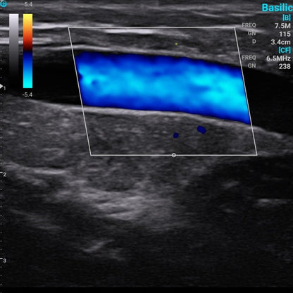 Chison Portable Ultrasound Machine “SonoEye” P2 (with 7.5 MHz linear transducer)