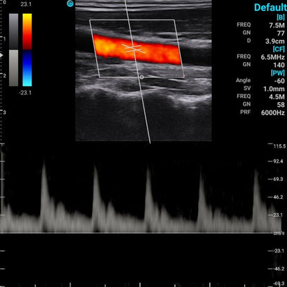 Chison Portable Ultrasound Machine “SonoEye” P7 (with 7.5 MHz linear rectal probe)
