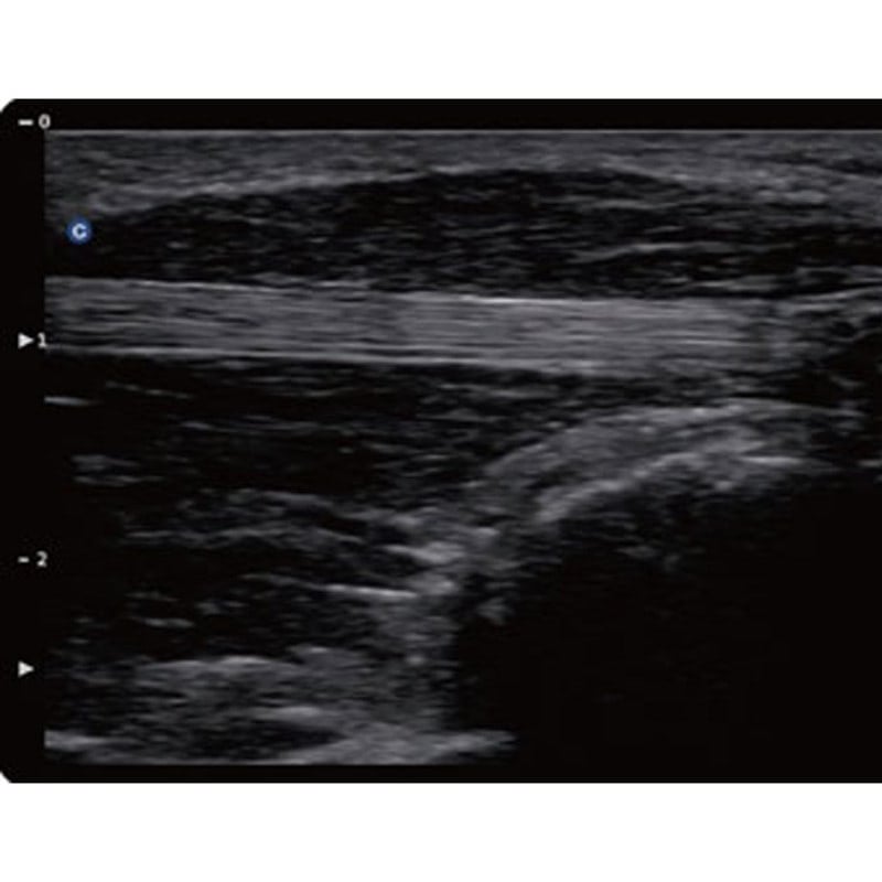 QBit 5 Ultrasound Machine without battery