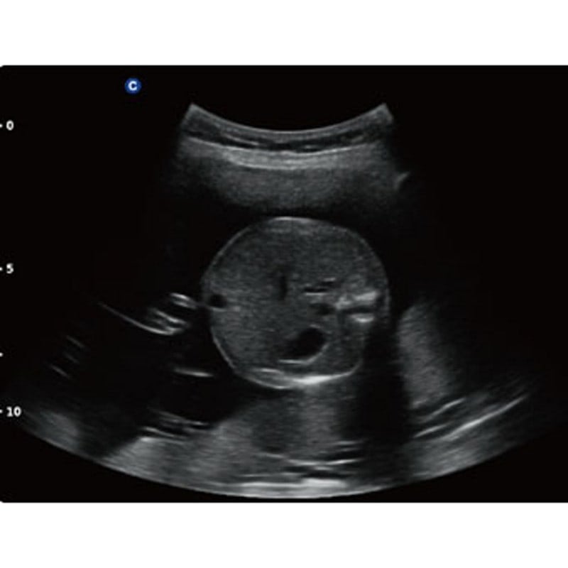 QBit 5 Ultrasound Machine with battery