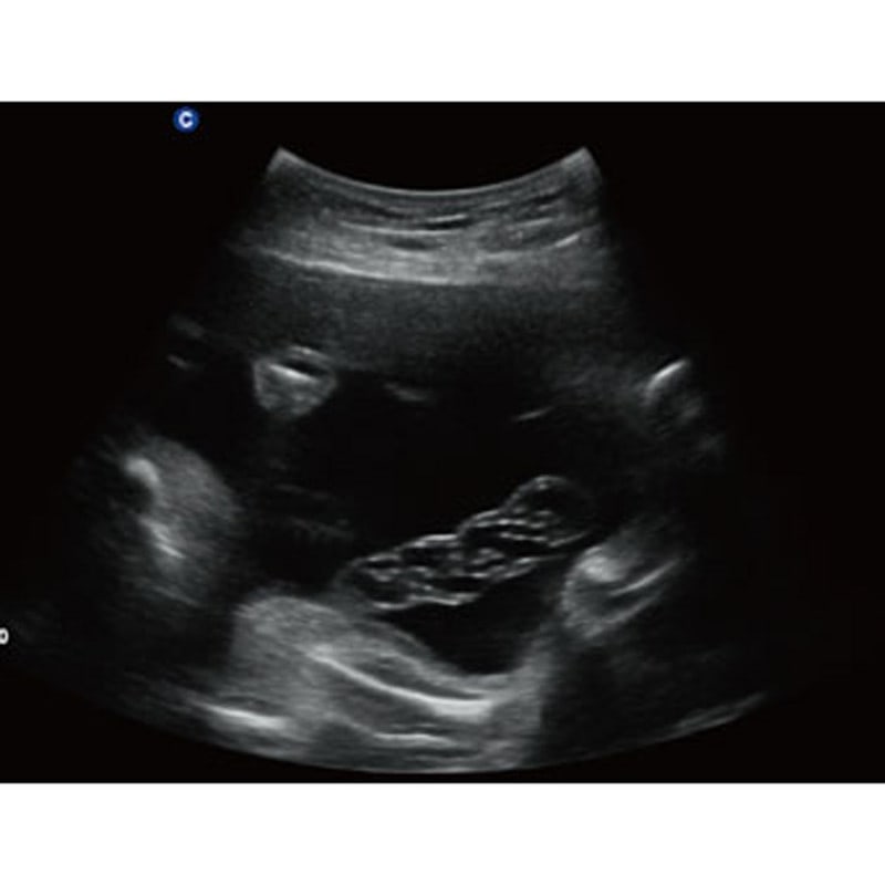 QBit 5 Ultrasound Machine without battery