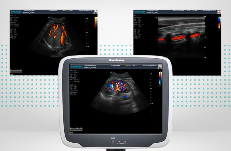 SonoScape S11 Plus ultrasound system without battery