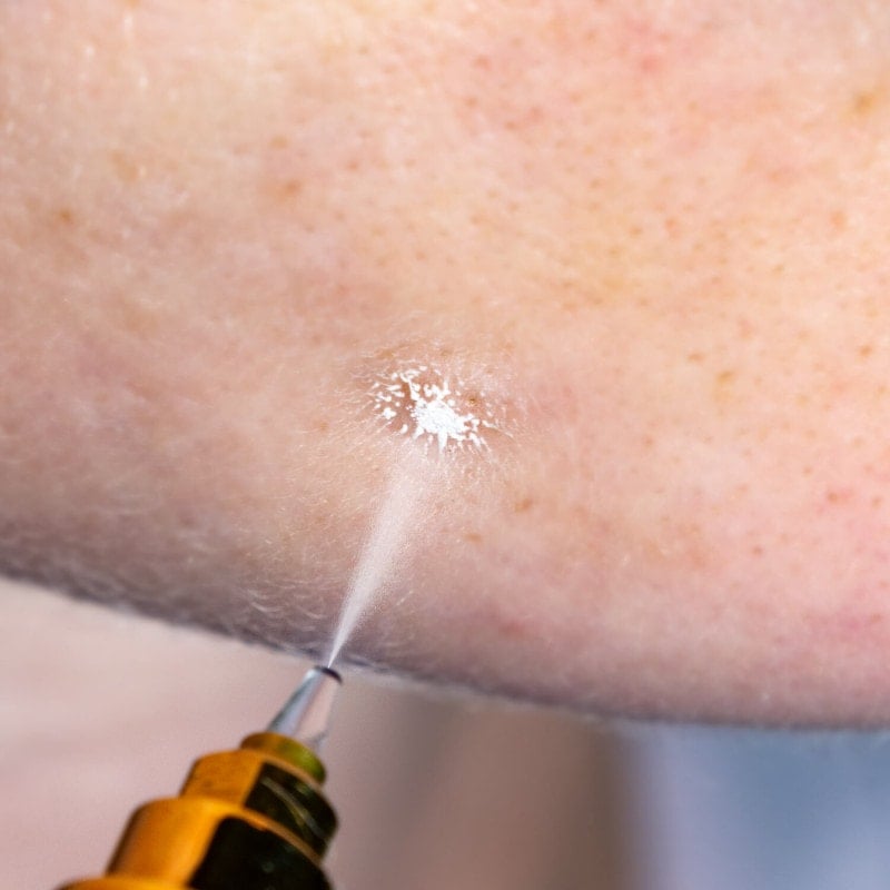 Cryoalfa SUPER Contact | in case
